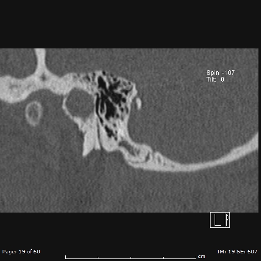 Cholesteatoma External Auditory Canal Image Radiopaedia Org