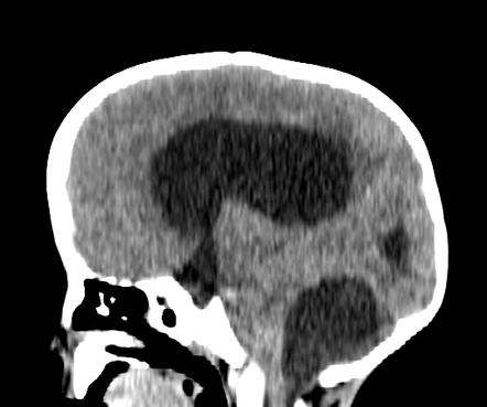 Arachnoid Cyst Posterior Fossa Radiology Case Radiopaedia Org