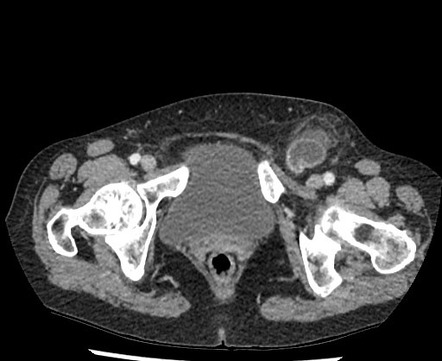 Small Bowel Obstruction Due To Entrapment In Femoral Hernia Image