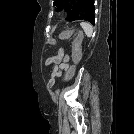 Ischemic Colitis Image Radiopaedia Org