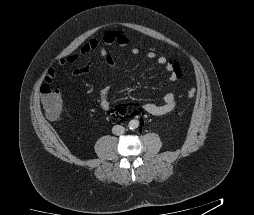 Perforated Diverticulitis With Free Gas In Peritoneal And