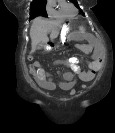 Gallstone Ileus Radiology Case Radiopaedia Org