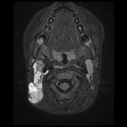 Cystic Lymphangioma With Intracystic Hemorrhage Image Radiopaedia Org