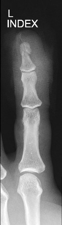 Distal Phalanx Fracture Radiology Case Radiopaedia Org