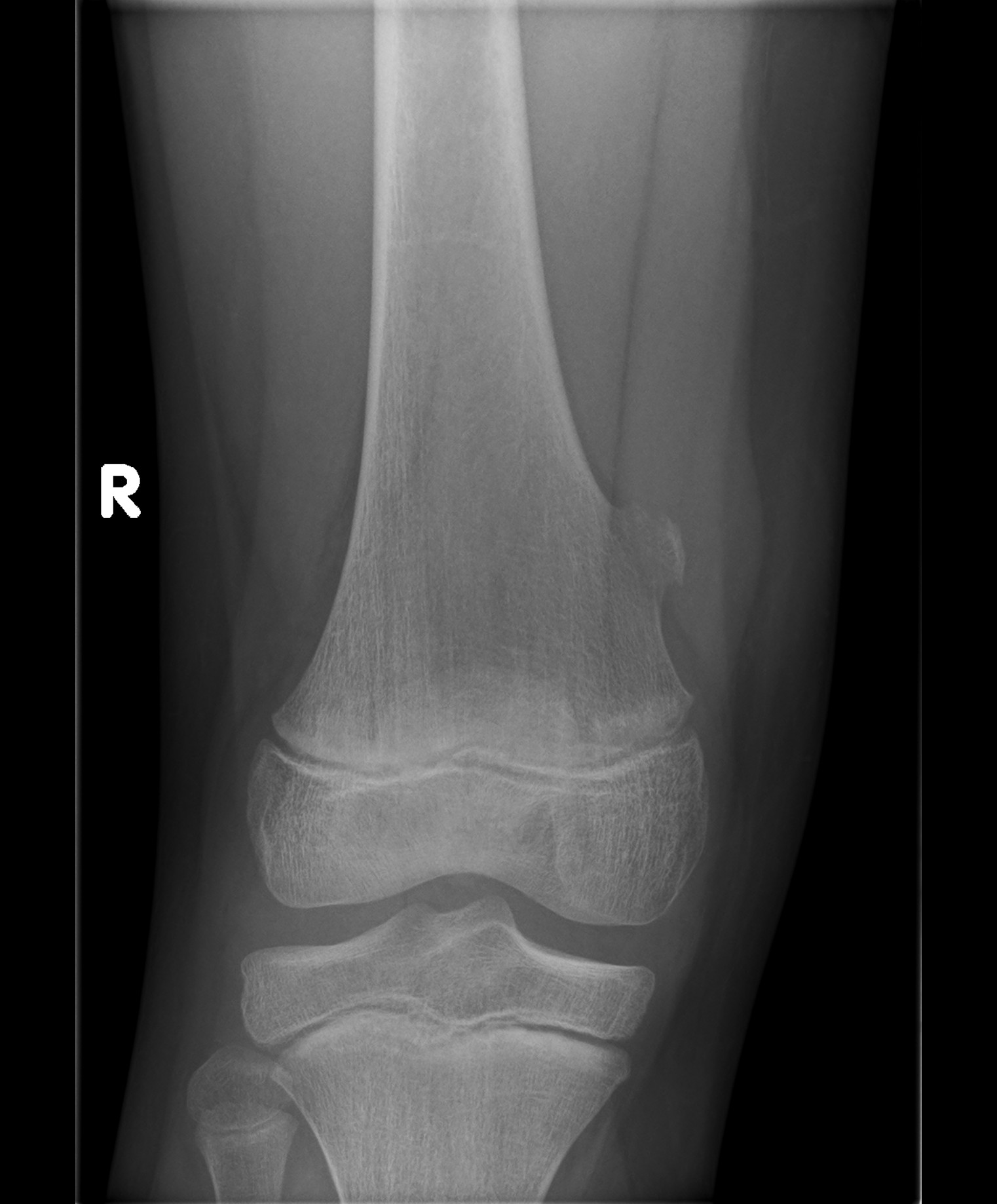 Osteochondroma Femur Image Radiopaedia Org