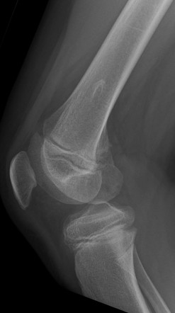 Osteochondroma Femur Image Radiopaedia Org