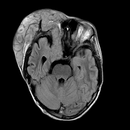 Plexiform Neurofibroma Image Radiopaedia Org