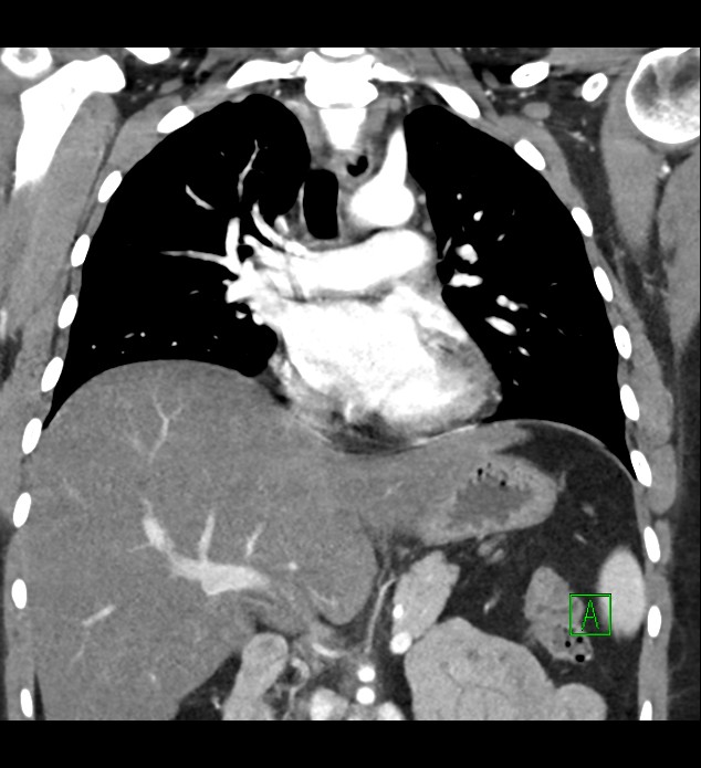 Primary Mediastinal Large B Cell Lymphoma Image Radiopaedia Org