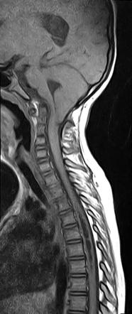 Chiari I With Syrinx And Skull Base Anomalies Radiology Case Radiopaedia Org