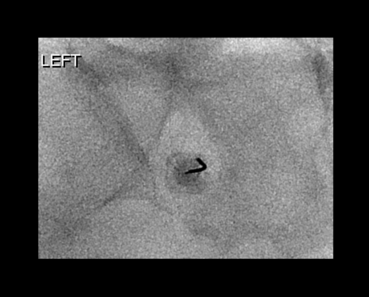 S Transforaminal Epidural Steroid Injection Fluoroscopic Guided