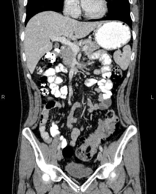 Colocolic Intussusception Image Radiopaedia Org