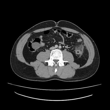 Viewing Playlist Abdominal Radiopaedia Org