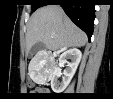 Adrenal Adenoma Radiology Reference Article Radiopaedia Org