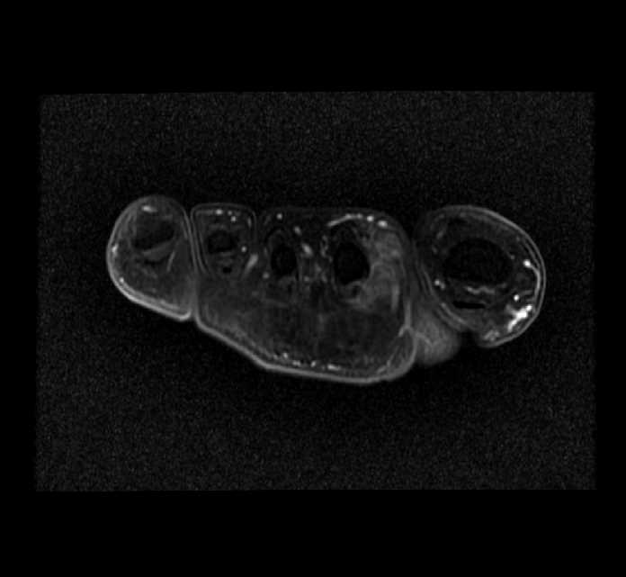 Giant Cell Tumor Of Tendon Sheath Image Radiopaedia Org