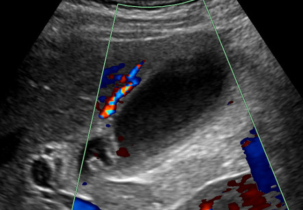 Acute Acalculous Cholecystitis Salmonella Image Radiopaedia Org