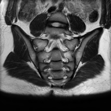 Normal Sacroiliac Joints Years Old Mri Radiology Case