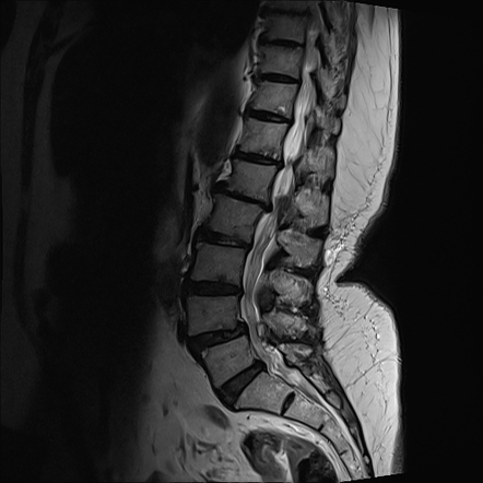 Ligamentum Flavum Cyst Radiology Case Radiopaedia Org