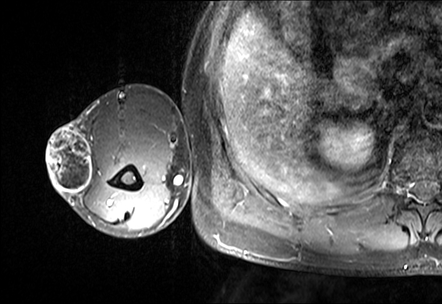 Pilomatricoma Image Radiopaedia Org