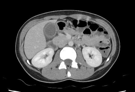 Acute Acalculous Cholecystitis Salmonella Radiology Case