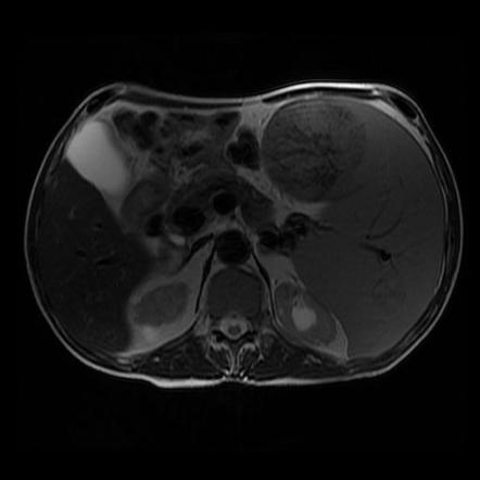 Extramedullary Hematopoiesis Radiology Reference Article