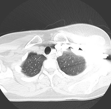 Epicardial Fat Necrosis Image Radiopaedia Org