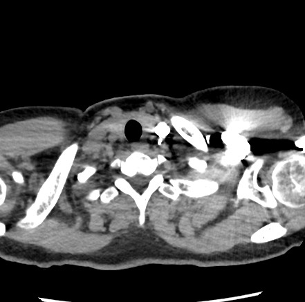 Epicardial Fat Necrosis Image Radiopaedia Org