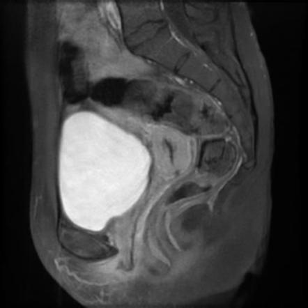 Cystic Adenomyosis Image Radiopaedia Org