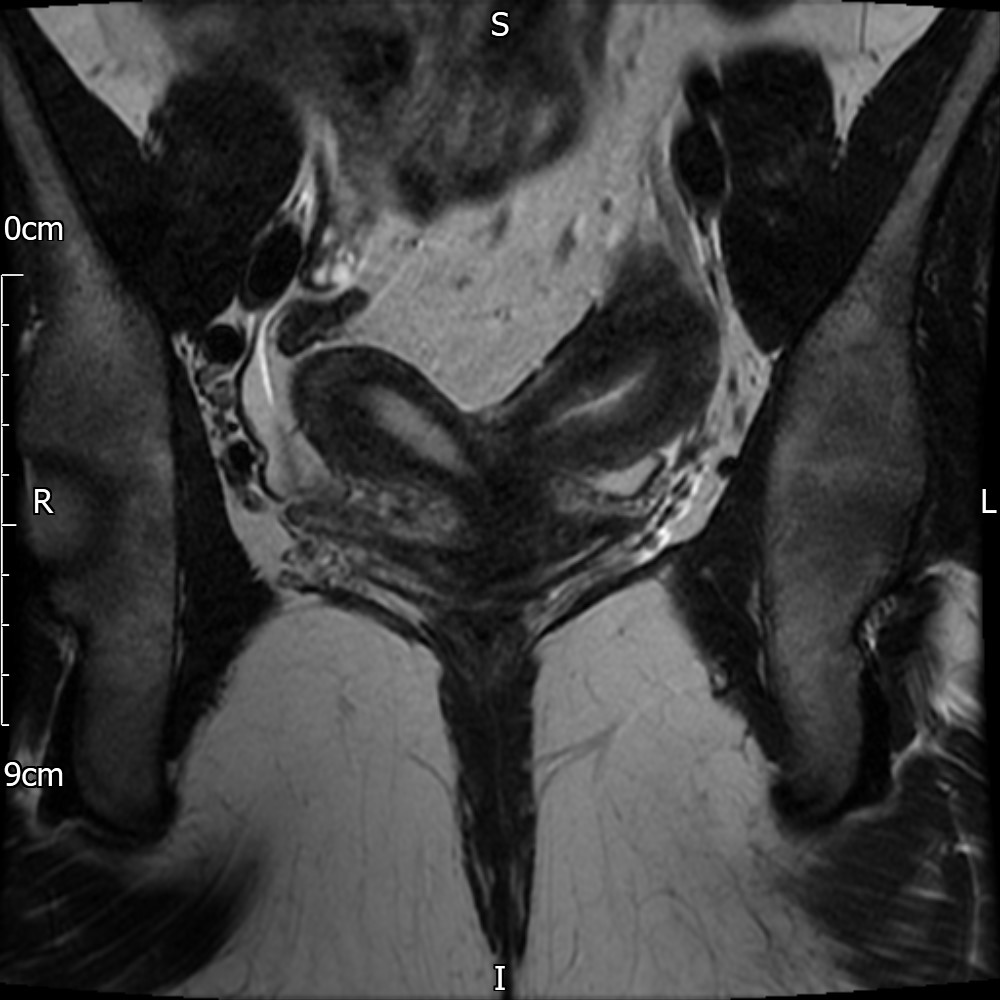 Uterus Didelphys Image Radiopaedia Org