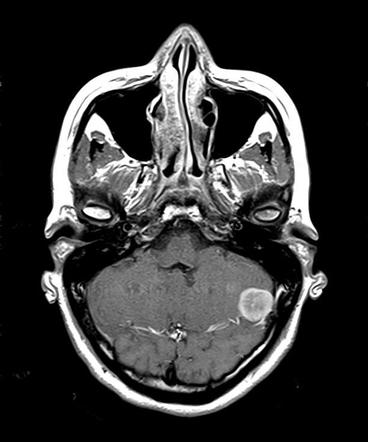 Meningioma Posterior Cranial Fossa Radiology Case Radiopaedia Org