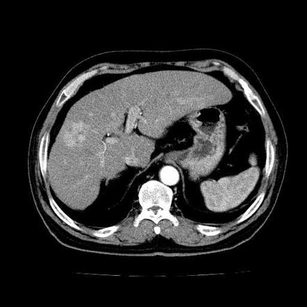 Renal Cell Carcinoma Radiology Case Radiopaedia Org