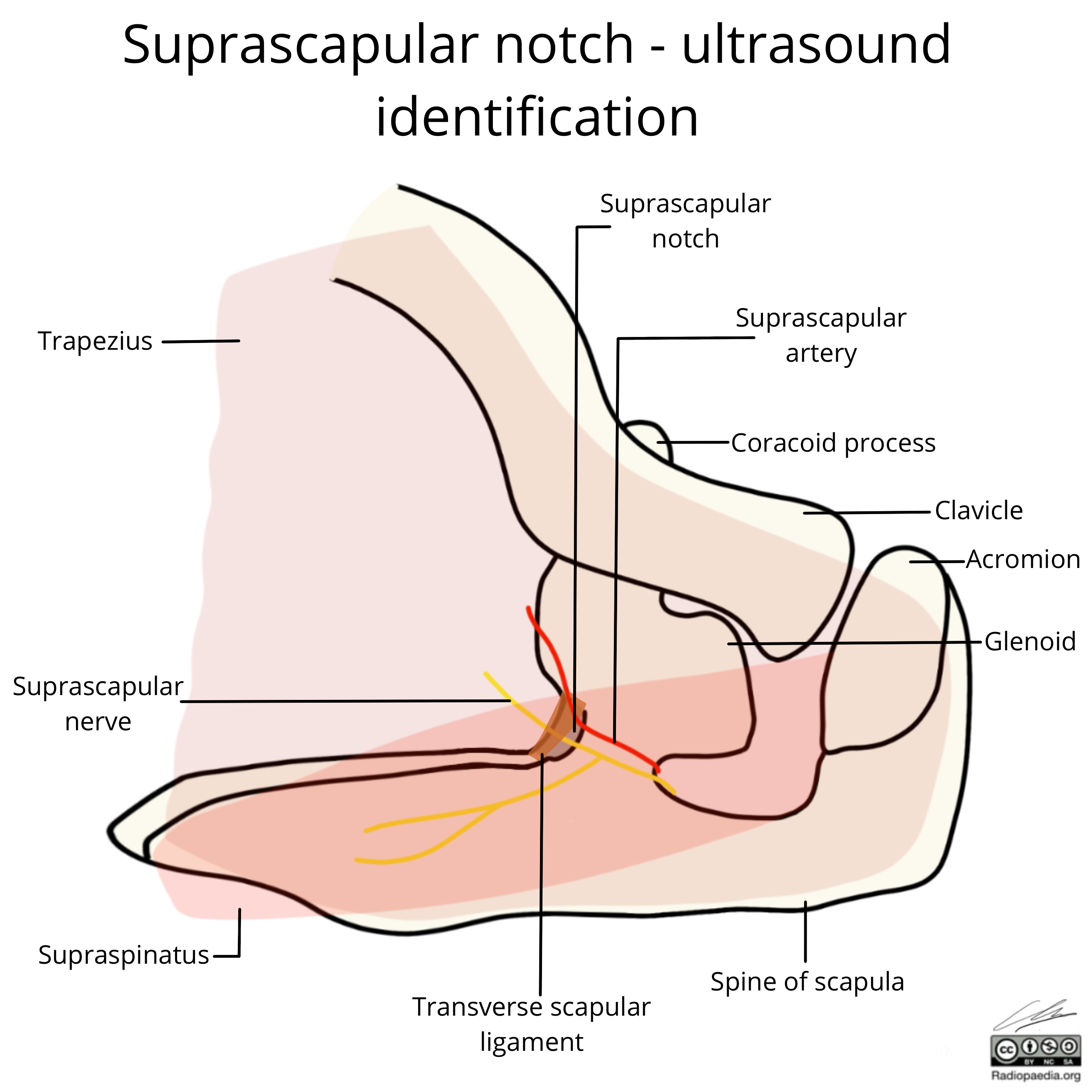 Suprascapular Notch Ultrasound Identification Image Radiopaedia Org