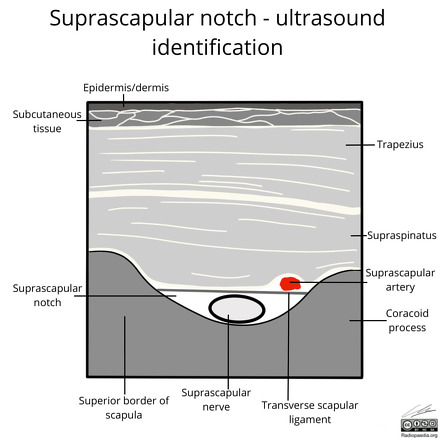 Suprascapular Notch Ultrasound Identification Image Radiopaedia Org