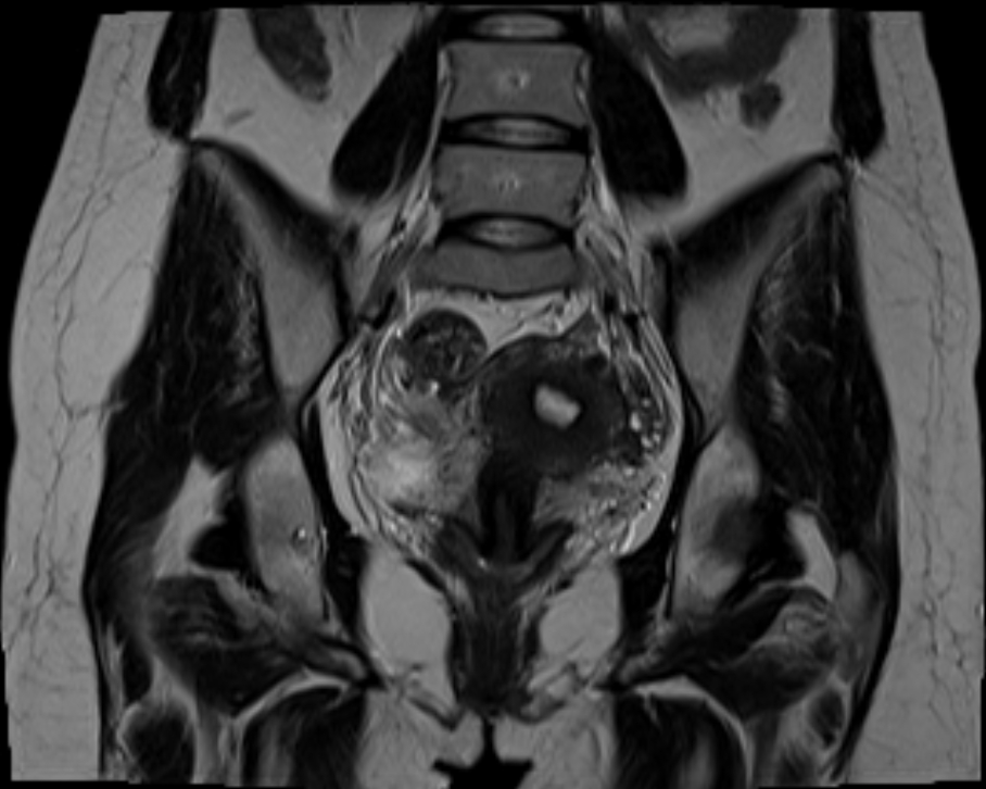 Ovarian Endometrioma Image Radiopaedia Org