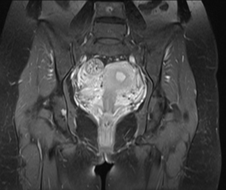 Ovarian Endometrioma Image Radiopaedia Org