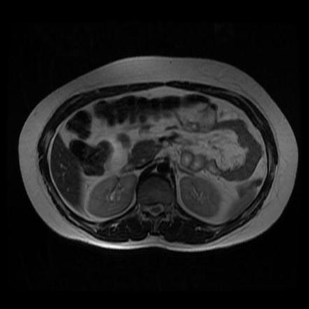 Ovarian Serous Cystadenoma Image Radiopaedia Org