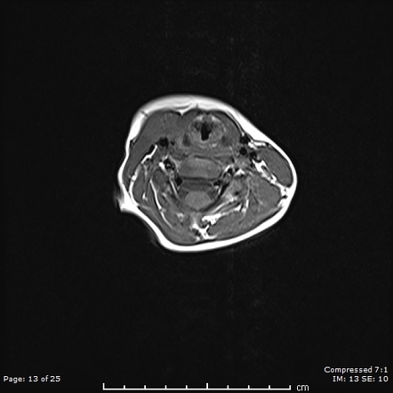 Cervical Ectopic Thymus Radiology Case Radiopaedia Org