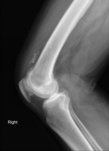 Synovial Chondromatosis Radiology Reference Article Radiopaedia Org