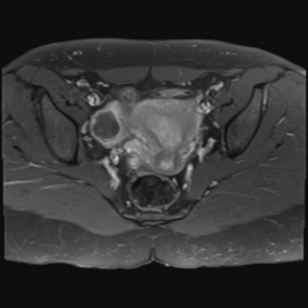 Ectopic Pregnancy Radiology Case Radiopaedia Org