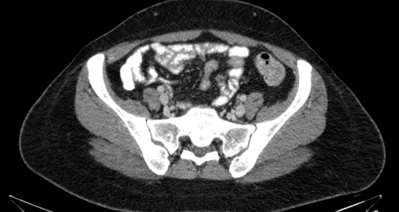 Mature Cystic Ovarian Teratoma Image Radiopaedia Org