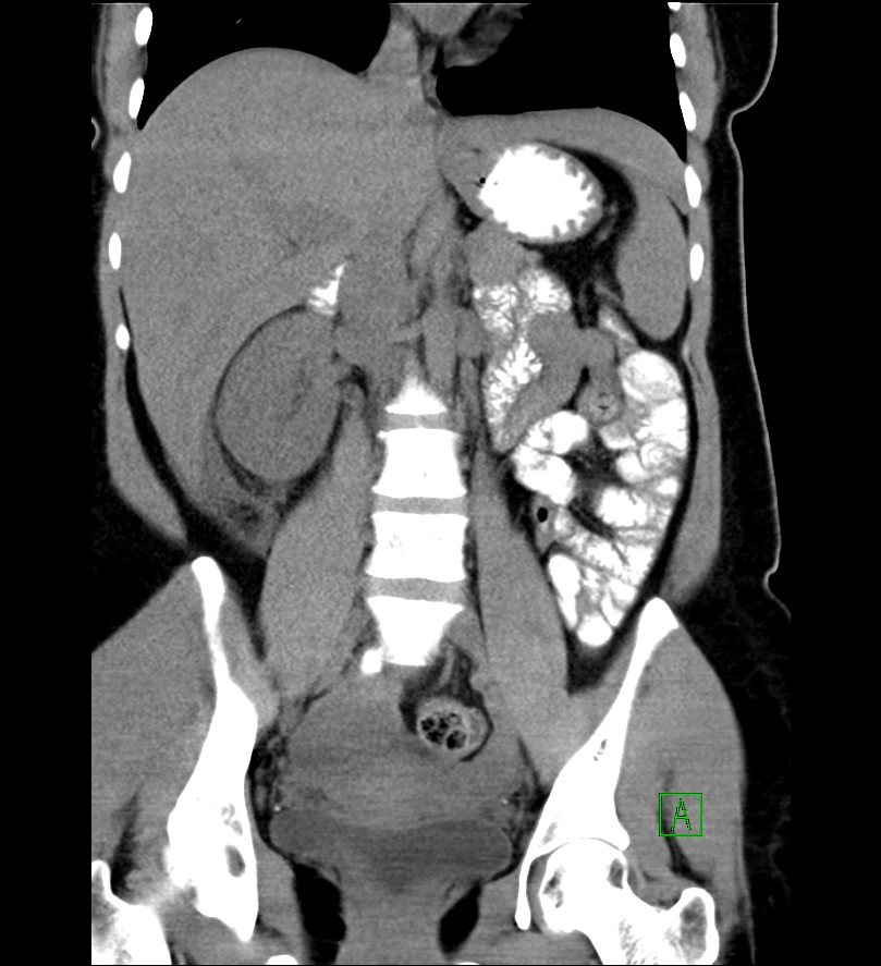 Subhepatic Appendicitis Image Radiopaedia Org