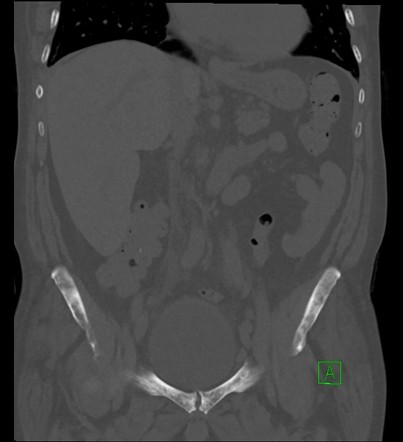 Sickle Cell Disease Abdominal Manifestations Image Radiopaedia Org