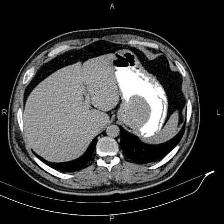 Gastrointestinal Stromal Tumour Of The Stomach Radiology Case