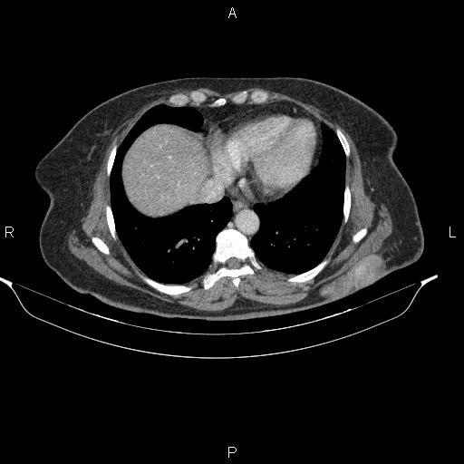 Dermatofibrosarcoma Protuberance Image Radiopaedia Org