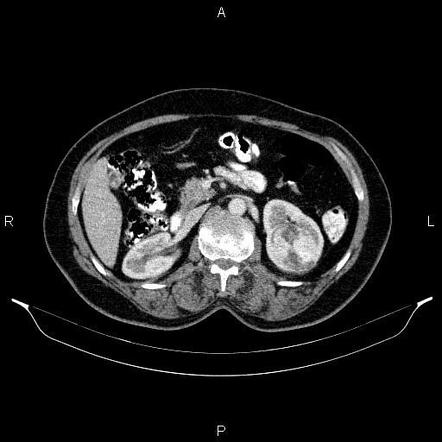 Renal Cell Carcinoma Radiology Case Radiopaedia Org