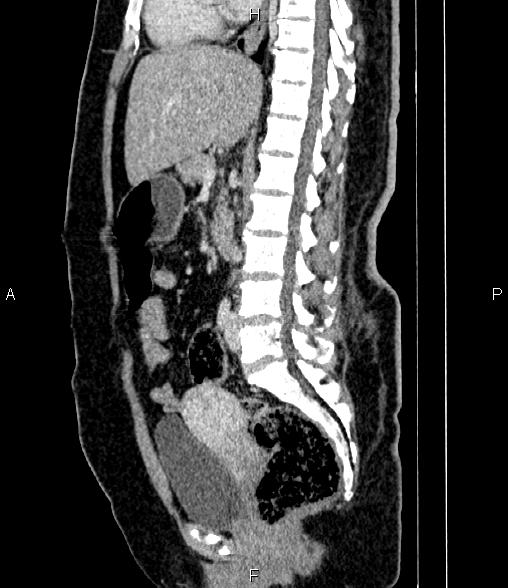 Renal Cell Carcinoma Image Radiopaedia Org