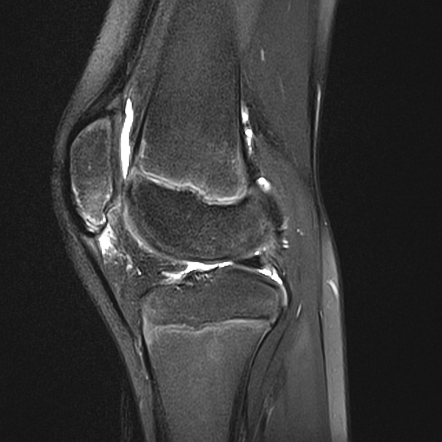 Patellar Sleeve Fracture Radiology Reference Article Radiopaedia Org