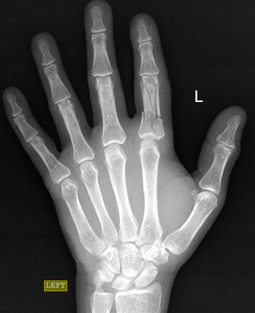 Proximal Phalanx Fracture Radiology Case Radiopaedia Org