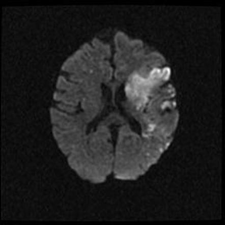 Multifocal Ischemic Stroke Image Radiopaedia Org