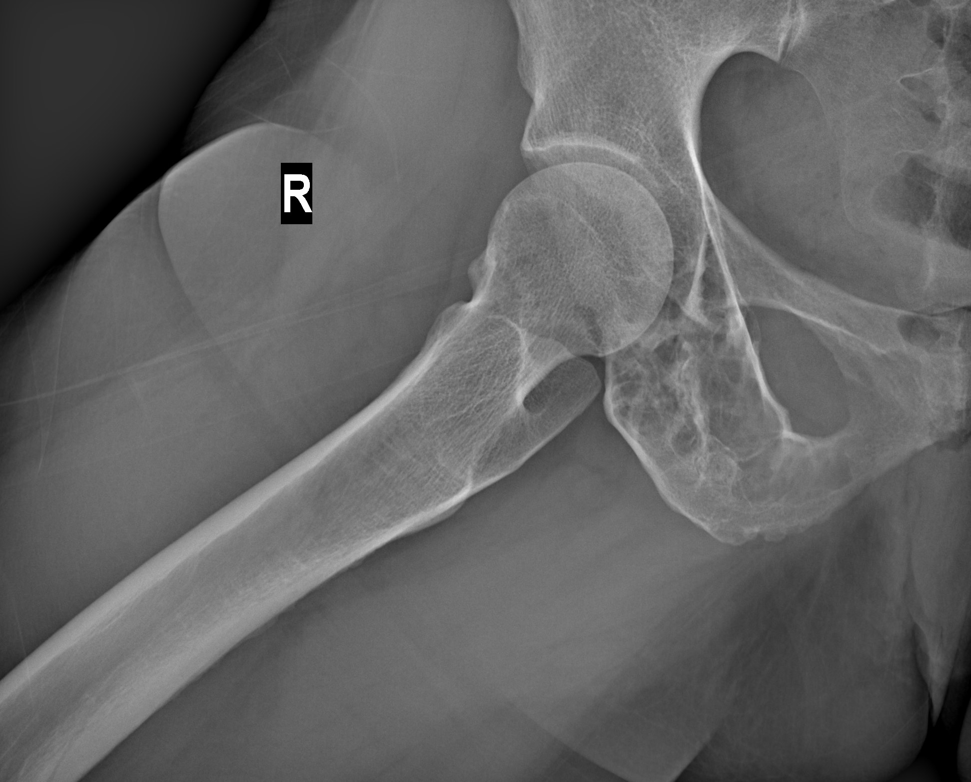 Acetabular Intraosseous Lipoma Image Radiopaedia Org