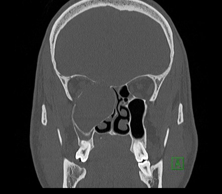 Mucocele Of The Ethmoidal Sinus Radiology Case Radiopaedia Org